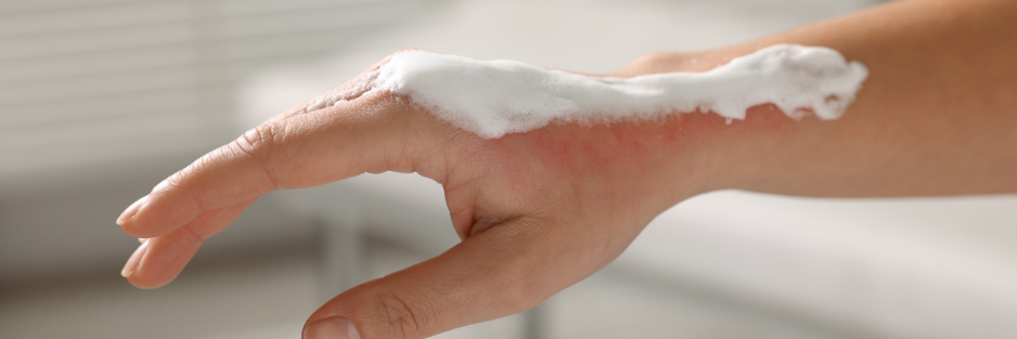 University > First Aid, Safety and Protection > Burn Treatment and Creams