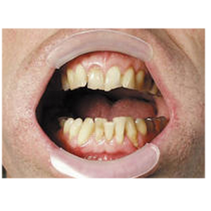 H&W Labia-Ex Lip Retractor, 2 small and 2 medium/Kit Kit