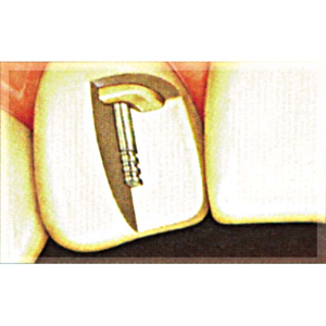 Op Po Temporary Posts Blue 1.75mm 20/pk Pack
