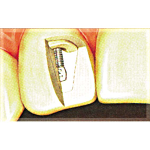 Op Po Precious Posts Pink 1.25mm 20/pk Metal Pack