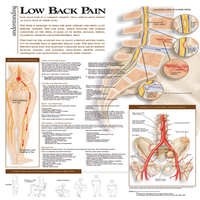 Chart, "Understanding Low Back Pain" 51 x 66cm, Rigid, Each Each